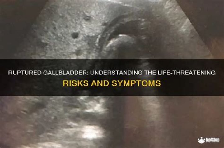 can a ruptured gallbladder kill you