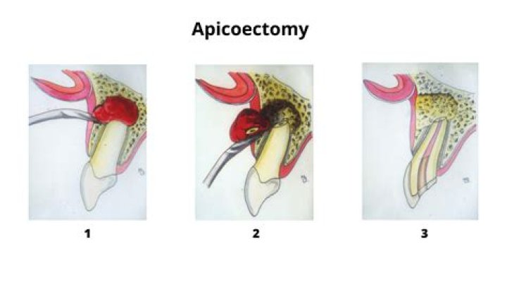 signs of a failed apicoectomy