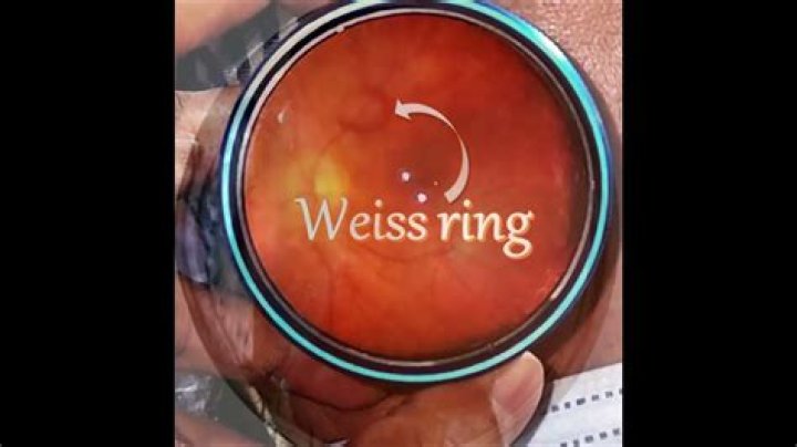 What causes Weiss rings?